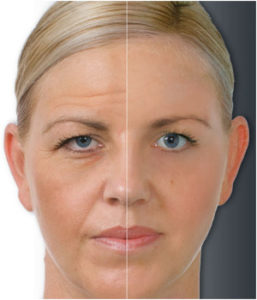 botox_3
