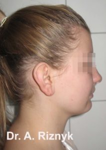 пластика вушної раковини фото