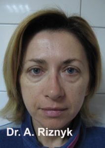пластика обличчя до і після
