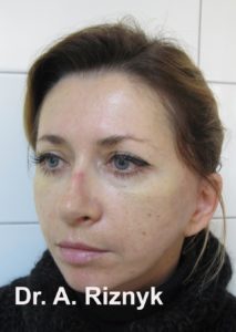 результати операції з омолодження обличчя
