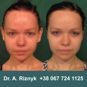 Пластика вуха у дітей